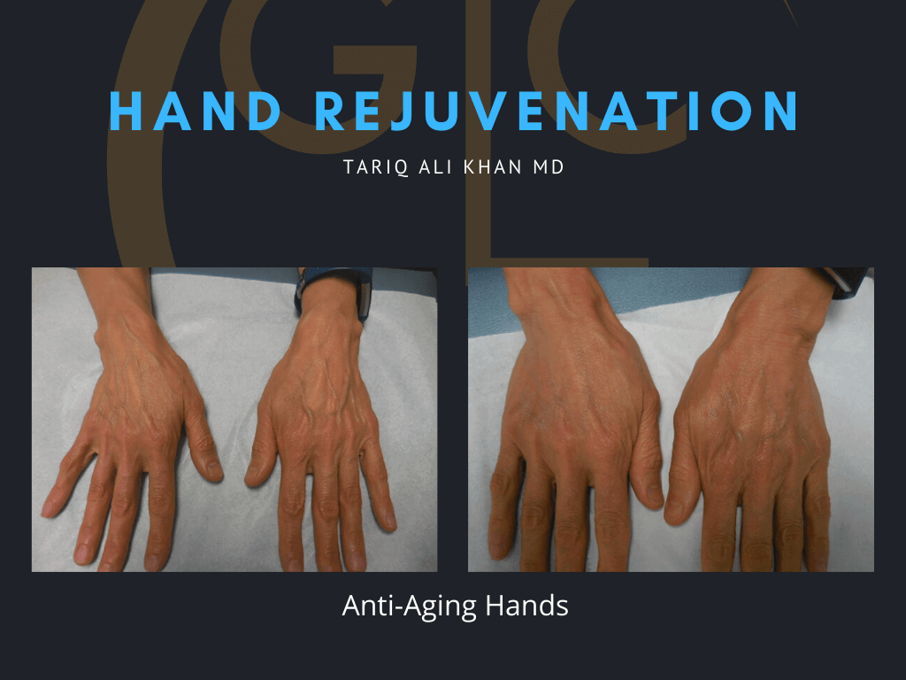 Gentle Care Laser Tustin & Long Beach Before and After picture - Hand Rejuvenation